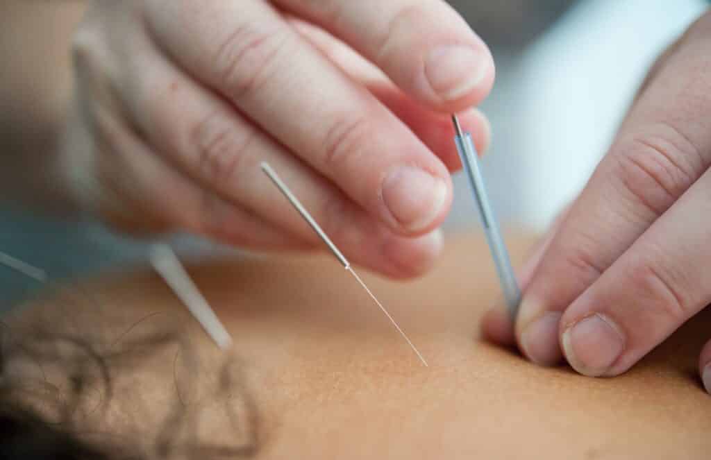 acupuntura para adelgazar